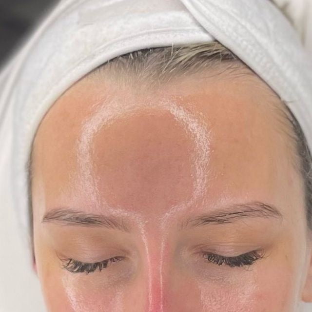 Cosmelan MD Peel